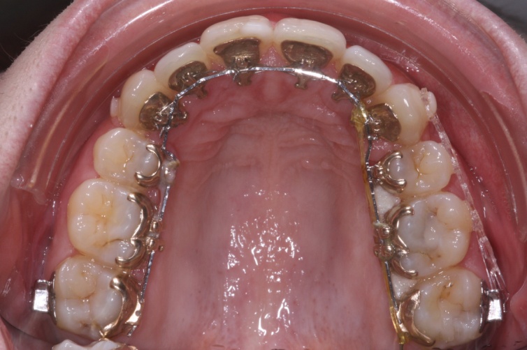  INCOGNITO orthodontie linguale invisible, bagues collées à l'interieur